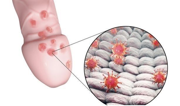 Allergic to penis enlargement gel