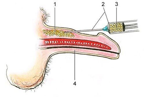 Injecting fatty tissue under the skin of the penis